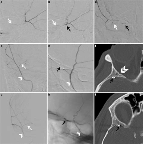 Middle meningeal artery (MMA) meningolacrimal branches and mimic ...