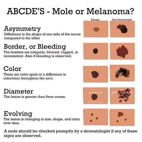 abcde-melanoma | SleekPhysique, LLC.