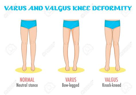 SAMARPAN PHYSIOTHERAPY CLINIC: Knee Valgus Deformity : Overview: