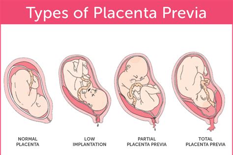 Complications And Risks of Placenta Previa During Pregnancy