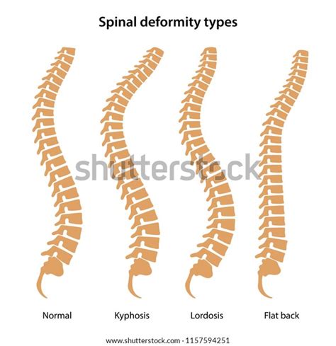 Spinal Deformity Types Vector Illustration Stock Vector (Royalty Free ...