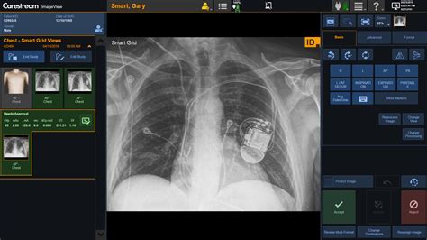 Carestream Releases ImageView Software for DRX-Revolution Mobile X-ray ...