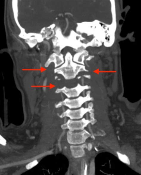 Vertebral Artery Ct Scan