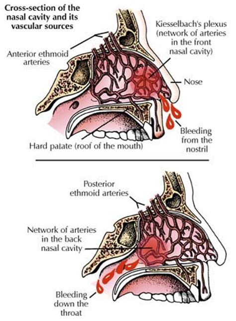 What Causes Nosebleeds? | Healthcare-Online