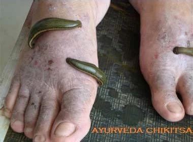 Leech Therapy Treatment in Ghaziabad | ID: 19013298291