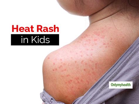 Fine Beautiful Info About How To Get Rid Of Heat Rash ...