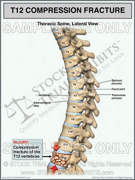 T12 Compression Fracture of Thoracic Spine | Thoracic, Anatomy, Spines