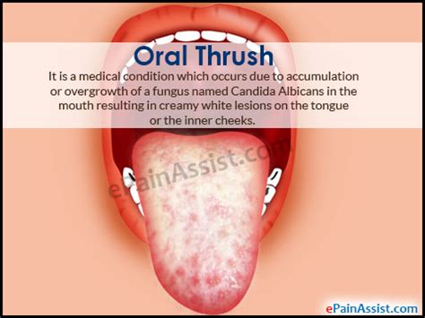 Oral Thrush: Causes, Treatment, Home Remedies, Prevention