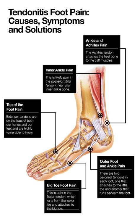 Tendonitis Foot Pain: Causes, Symptoms and Solutions – The Amino Company