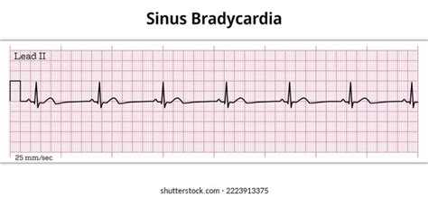 Vektor Stok Ecg Sinus Bradycardia 8 Second Ecg (Tanpa Royalti ...