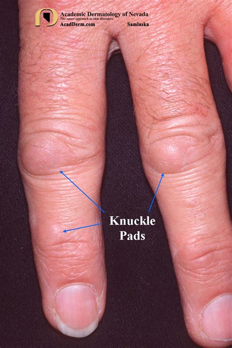 Knuckle Pads: Heloderma... - Academic Dermatology of Nevada