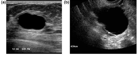 What Does Breast Cancer Look Like On An Ultrasound