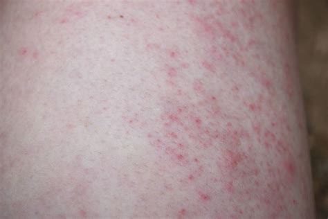 Heatwave 2019: Have I got sweat rash? Prickly heat rash symptoms ...