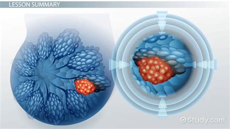 What is a Malignant Tumor? - Definition & Treatment - Lesson | Study.com