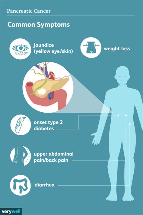 Pancreatic Cancer: Signs, Symptoms, and Complications