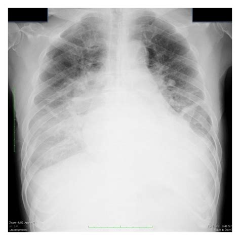 Chest X-ray at admission: significant pulmonary congestion and reduced ...