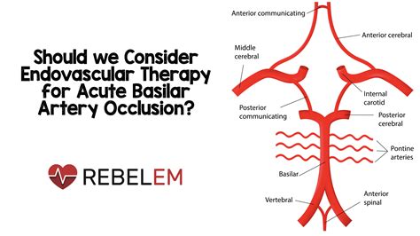 Should we Consider Endovascular Therapy for Acute Basilar Artery Occlu ...