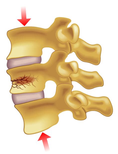 Compression Fracture - ONZ Spine