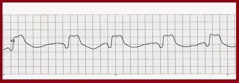 Float Nurse: Various Accelerated Idioventricular Rhythms