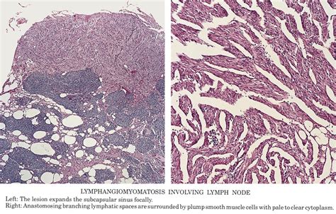 Pathology Outlines - Lymphangiomyomatosis