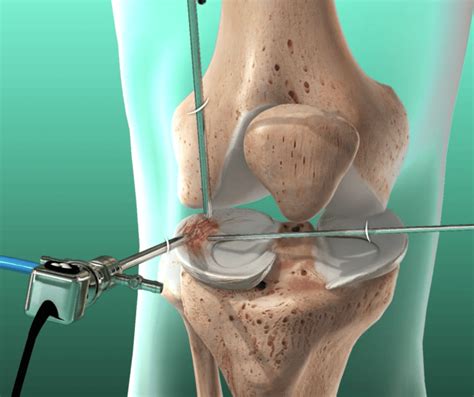 Meniscus Repair | Board Certified Orthopedic Surgeons