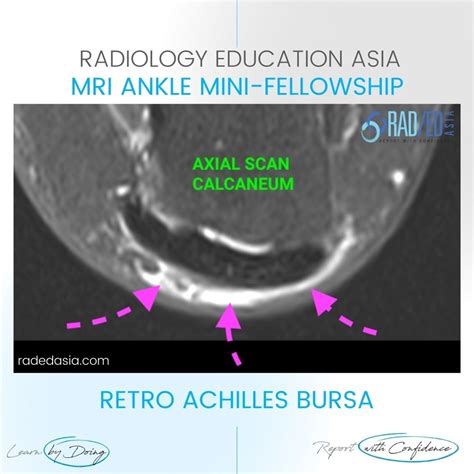 RETROACHILLES BURSA BURSITIS MRI RADIOLOGY ANKLE - Radedasia