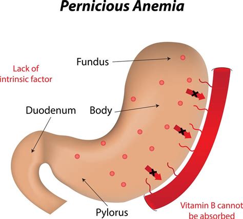 Vitamin B12 deficiency Guide: Causes, Symptoms and Treatment Options