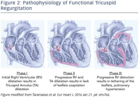 Management of Tricuspid Regurgitation: The Role of Transcatheter ...