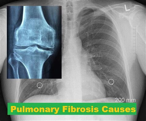 Pulmonary Fibrosis: 7 Causes, Symptoms, And Treatment