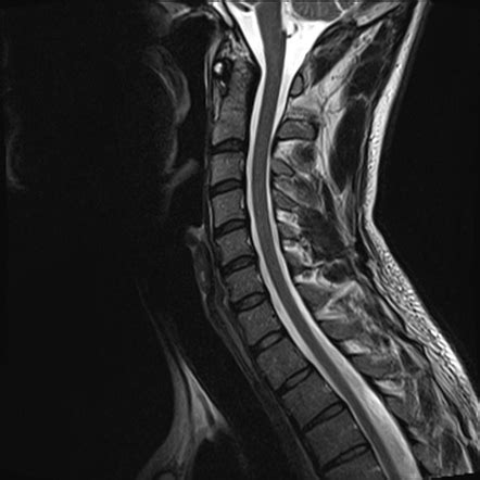 Normal Cervical Spine