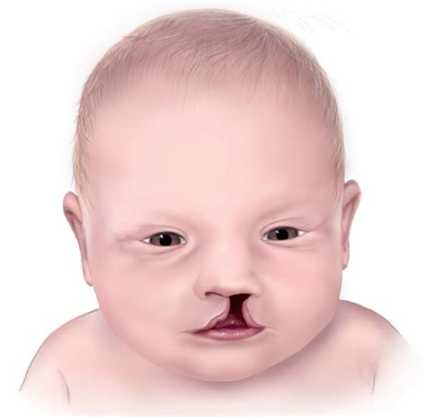 Cleft Palate & Cleft Lip - Causes, Symptoms, Repair, Surgery