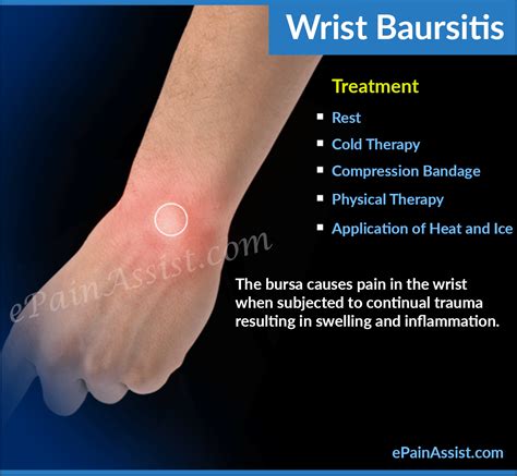 Wrist Bursitis|Causes|Symptoms|Treatment|Physical Therapy|Exercises|