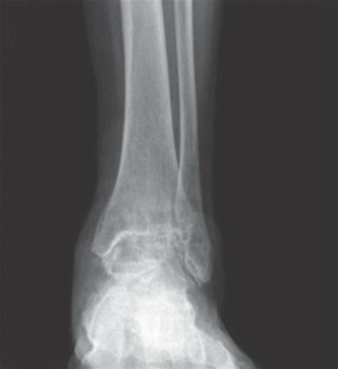 Ankle Arthrodesis - Foot & Ankle - Orthobullets