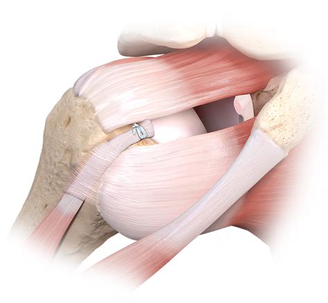 Arthrex - Loop 'N' Tack™ Biceps Tenodesis Technique