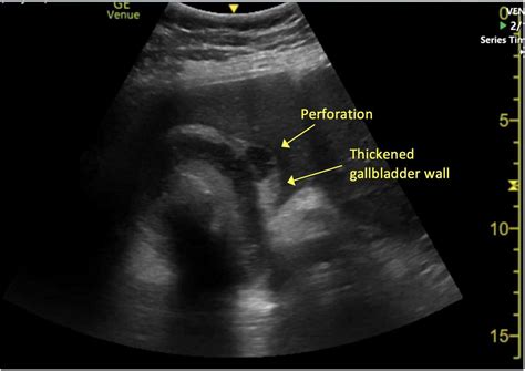 Perforated gallbladder : r/Radiology