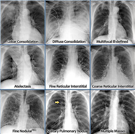 Chest X Ray Pneumonia Vs Lung Cancer - CancerWalls