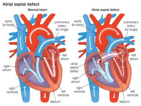 Atrial Septal Defect (ASD) Explained