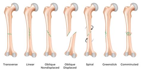 Comminuted Fracture | Causes, Symptoms And Recovery