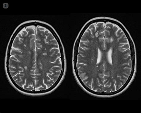 A breakdown of multiple sclerosis | Top Doctors