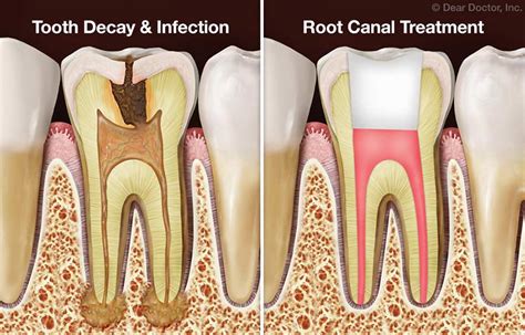 Root Canal Procedure at Lasting Smile Dental - Dentist in Washington