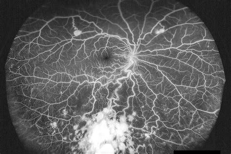 Fluorescein Angiography | Medivision