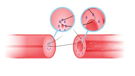 Advanced Micro-surgical Vasectomy Reversal by Multilayer Microdot ...