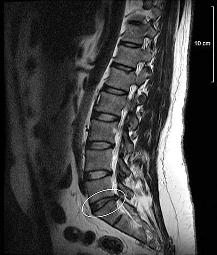 What Does A Pinched Nerve Look Like On An Mri - Where do pinched nerves ...