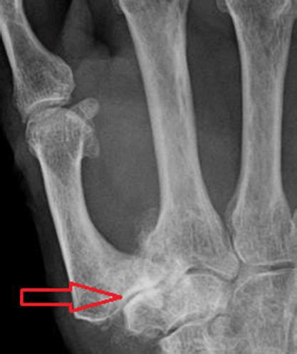 ‘Thumb’ Arthritis (Osteoarthritis) | HC Smart