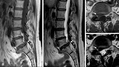 MRI. Herniated nucleus pulposus on the right side at the L5/S1 ...