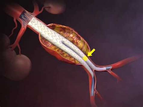 NEJM Procedure: Deployment of an Endovascular Graft in an Abdominal ...