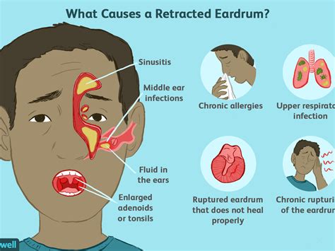 How To Drain Fluid Behind Eardrum At Home - Best Drain Photos Primagem.Org