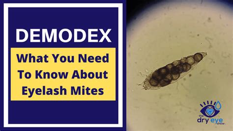 Demodex and What You Need to Know About Eyelash Mites - Eye Love