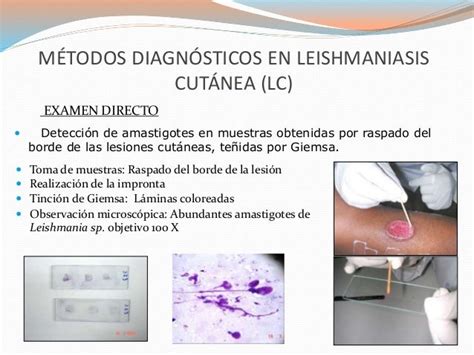 Mucosal Leishmaniasis