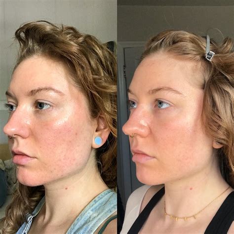 [B&A] Acne scar progress after 5 months of Curology/Tretinoin : r ...